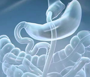 cirurgia bariátrica bypass