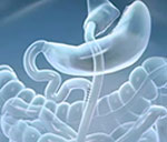 cirurgia bariátrica bypass