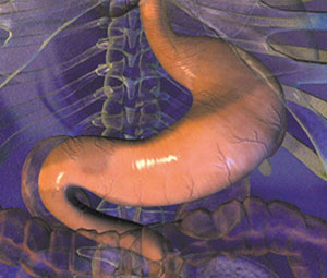 cirurgia bariátrica ou gastroplastia