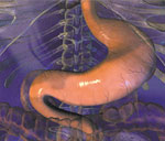 cirurgia bariátrica ou gastroplastia
