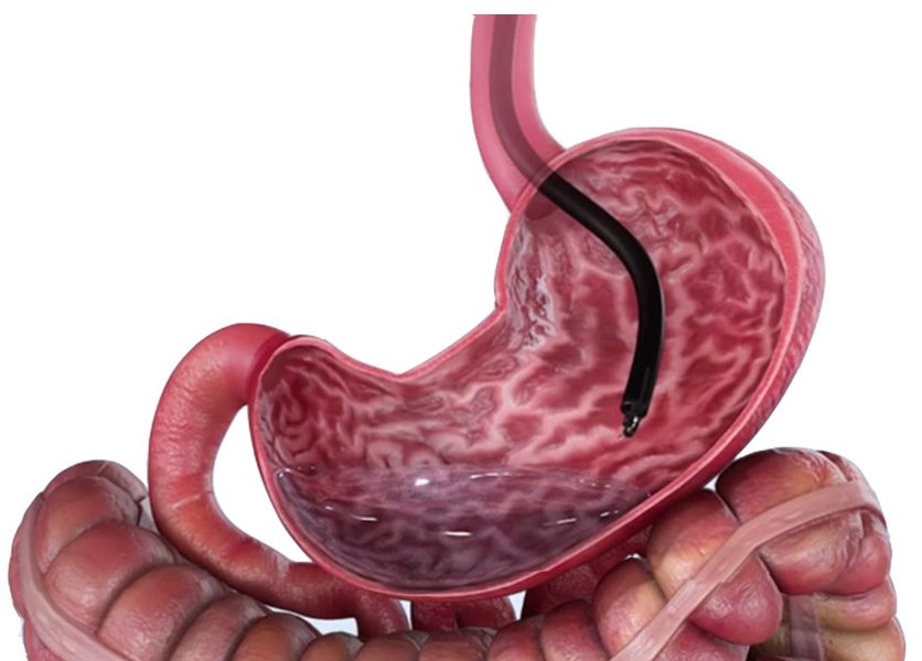 Gastroplastia endoscópica