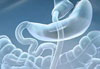 Cirurgia Bariatrica bypass