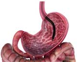 Gastroplastia endoscópica em Curitiba Gastroplastia endoscópica - Nova técnica bariátrica não faz corte ou incisões e paciente vai embora no mesmo dia!